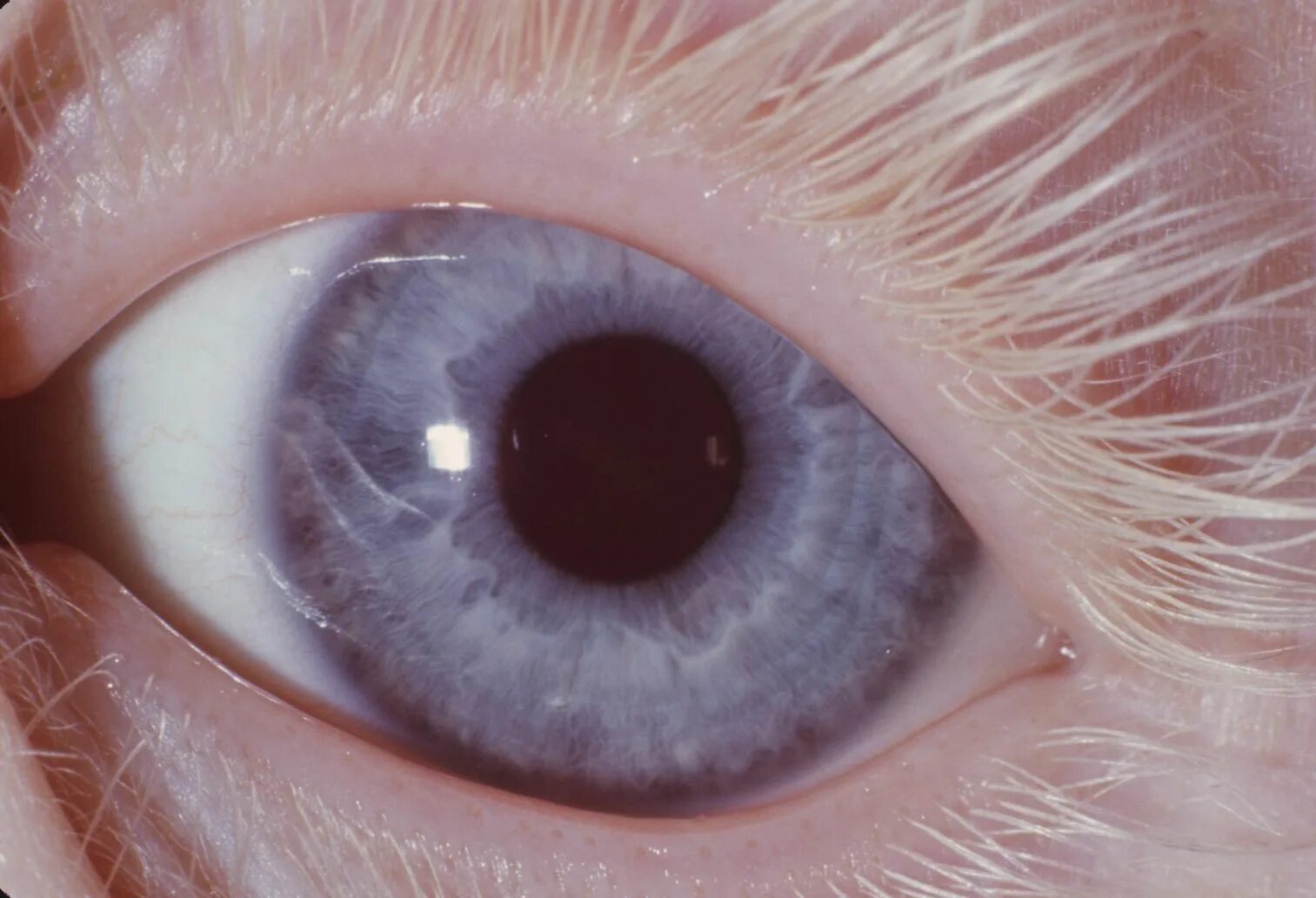 Глазокожный альбинизм 1 а. Альбинизм 1в. Без пигмента. Без пигмента. Глазокожный альбинизм 1 а.