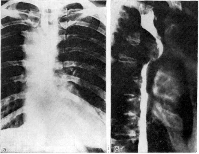 Туберкулез пищевода рентген. Дупликационная киста пищевода. Смещение пищевода рентгенограмма.