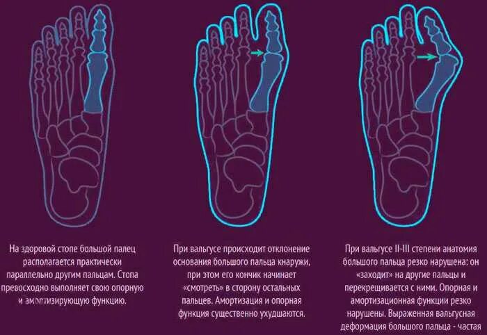 Почему щелкают ноги. Вальгусная деформация сустава большого пальца. Вальгусная деформация большого пальца плоскостопия. Вальгус деформация большого пальца стопы. Степени деформации стопы.