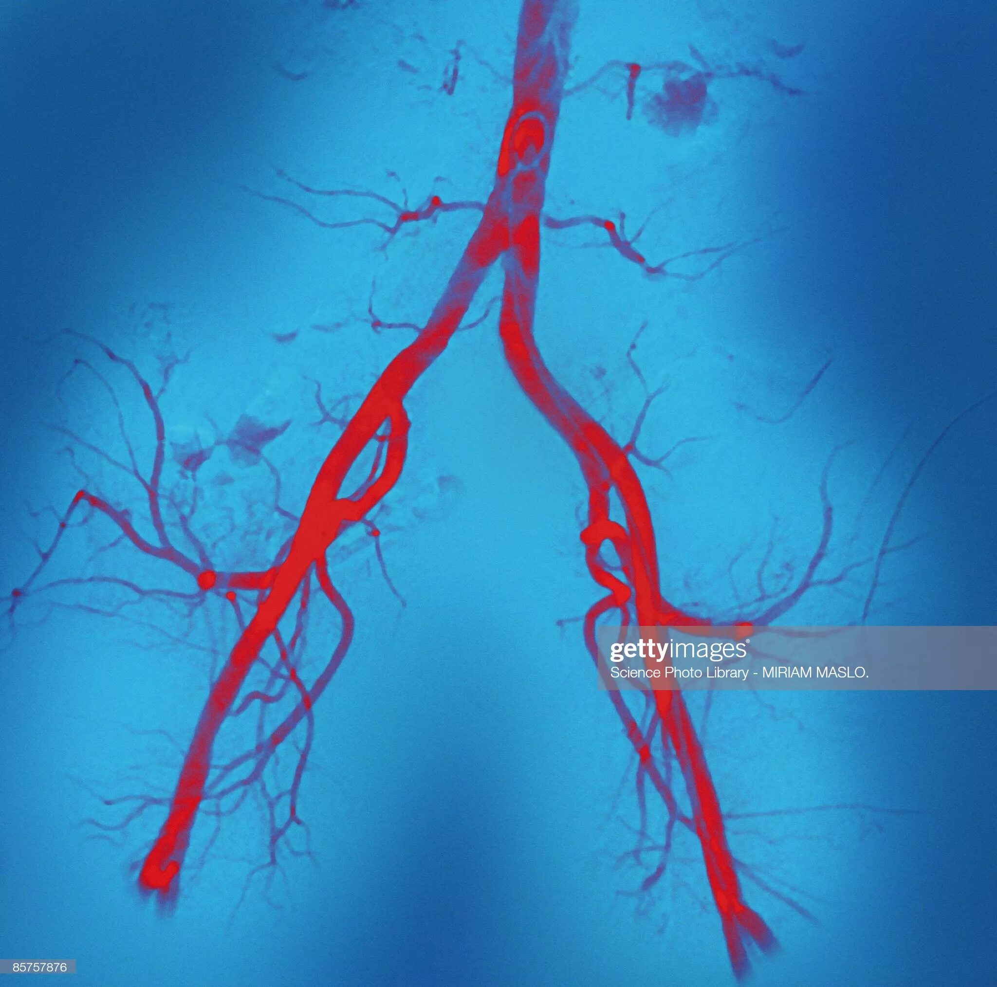 Пронизан кровеносными капиллярами. Ангиография артерий нижних конечностей (АНК). Артерии фон. Кровеносные сосуды в виде дерева.