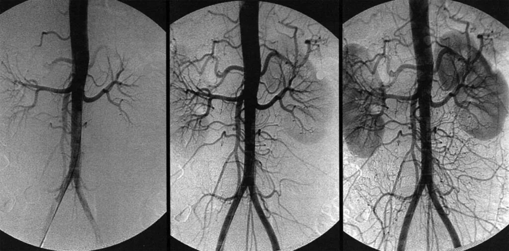 Ангиодистония сосудов. Селективная ангиография сосудов почек. Ангиодистония сосудов головного мозга что это такое. Селективная почечная артериография. Кт ангиография почечных артерий.
