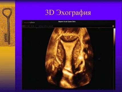 Эхография