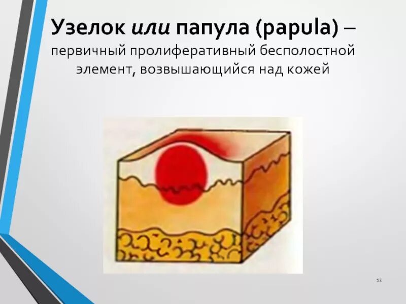 Папула элемент. Папула элемент