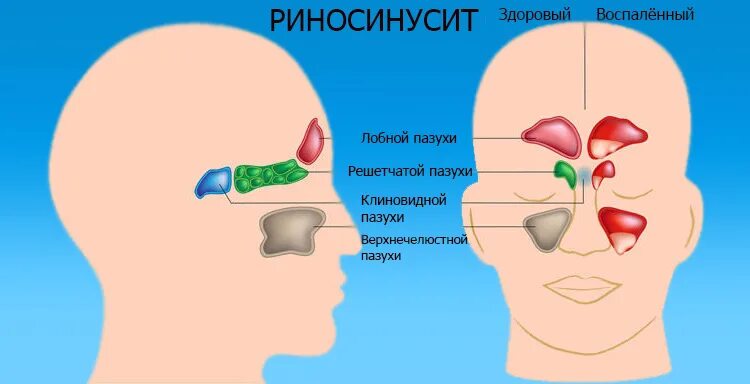 Болит переносица при нажатии насморка. Воспаленные пазухи носа. Воспаление носовых пазух.