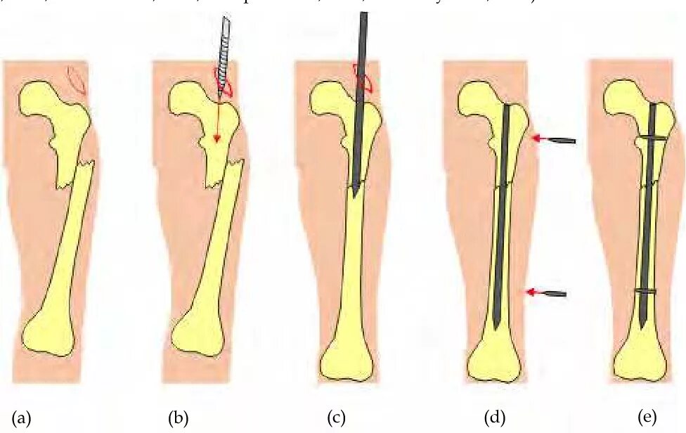 Сколько заживает бедро. Внутрикостный остеосинтез. Интрамедуллярный (внутрикостный) остеосинтез. Внутрикостный остеосинтез диафиза бедренной кости. Остеосинтез бедренной кости операция.