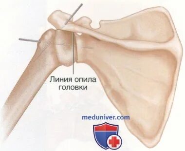 Проксимальный конец плечевой