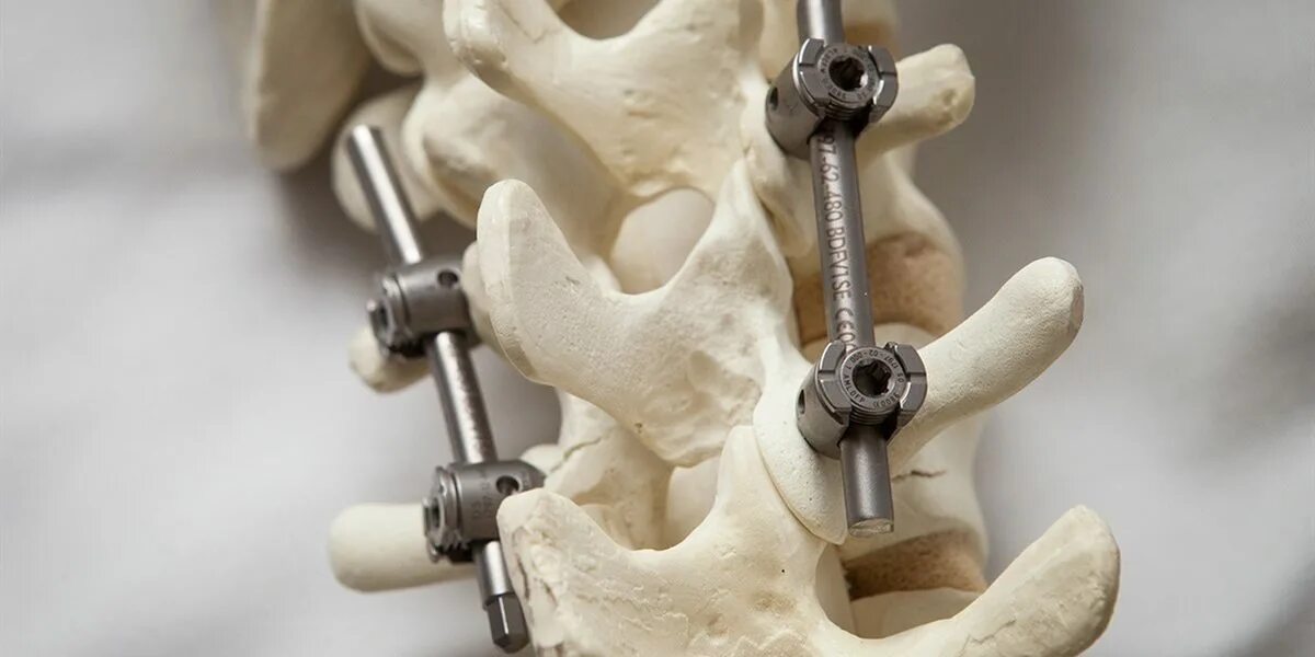 Транспедикулярная фиксация l5-s1. Артродез позвоночника спондилодез. Транспедикулярная фиксация l3 l4. Операция на дисках позвоночника