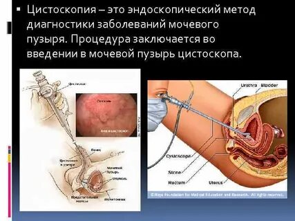 Удаление мочевого пузыря сколько длится операция