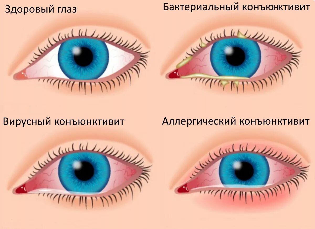Лечение коньюктивита взрослых