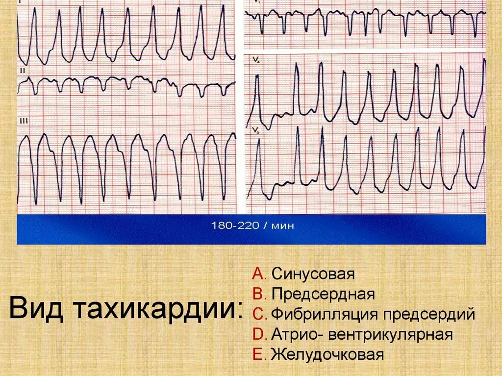 Синусовая тахикардия вертикальное. Тахикардия. Тахикардия на графике. Синусовая тахикардия. Синусовая тахикардия на ЭКГ.