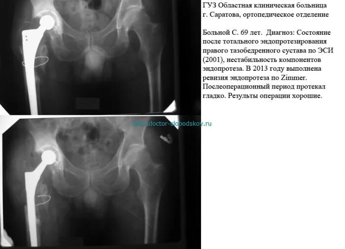Ревизия тазобедренного сустава. Нестабильность эндопротеза тазобедренного сустава кт. ревизионное тотальное эндопротезирование тазобедренного сустава:. тотальный эндопротез тазобедренного сустава рентген описание. ревизионная артропластика тазобедренного сустава.