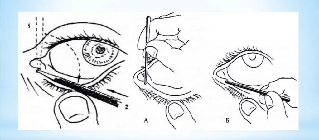 Массаж глаз слезного канала. Зондирование слезного канала у новорожденных. Массаж при непроходимости слезного канала у новорожденных. Непроходимость слезного канала массаж новорожденному. Дакриоцистит массаж слезного канала.