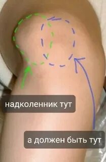Код мкб вывих надколенника