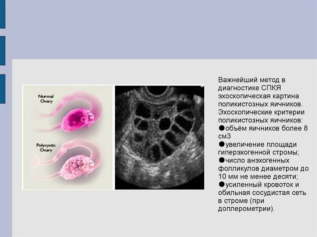 Поликистозные яичники лечение. Синдром поликистозных яичников диагностические критерии. СПКЯ лабораторные признаки. Клинические проявления СПКЯ. СПКЯ симптомы диагностика.