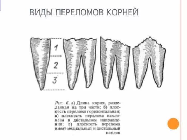 Продольный перелом корня зуба. Перелом корня переднего зуба.