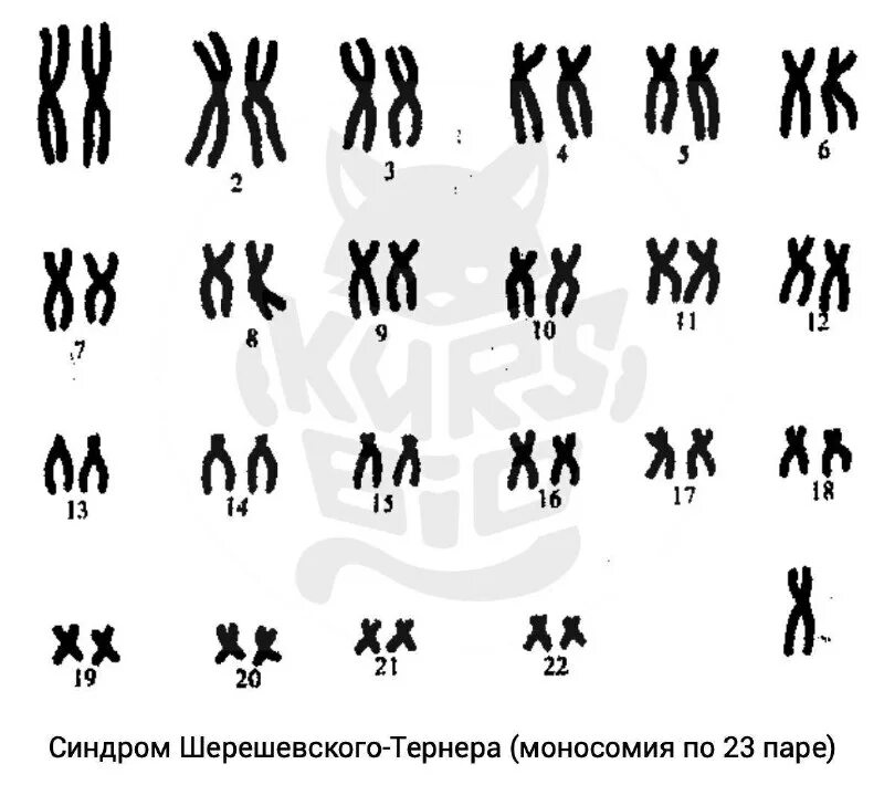 синдром шерешевского тернера кариограмма. синдром шерешевского тернера кариограмма. синдром шерешевского тернера кариограмма. синдром тернера кариотип. синдром шерешевского тернера набор хромосом.