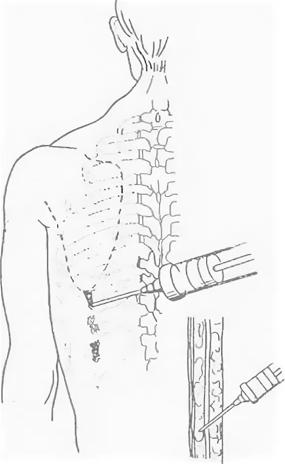 Межреберная блокада. Паравертебральная блокада межреберных нервов. Грудная паравертебральная блокада. Паравертебральная блокада в акушерстве. Иглы для паравертебральной блокады.