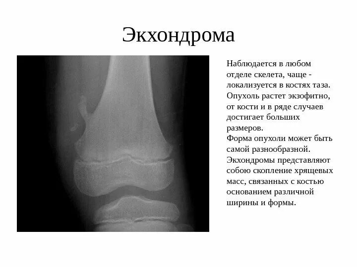 Эностозы большеберцовой кости. Энхондрома пястной кости. Энхондрома пястной кости рентген. Энхондрома метафиза бедренной кости. Энхондрома пястной кости рентген.