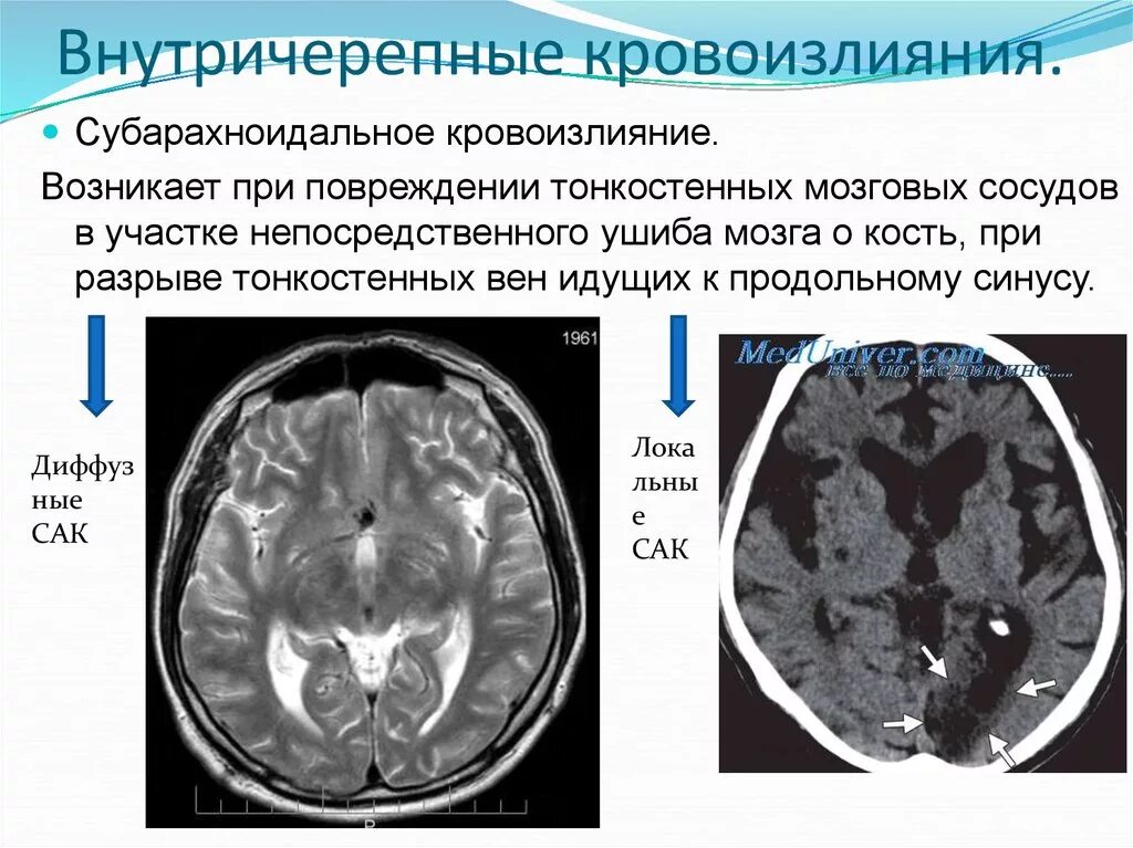 Повреждения головного мозга возникают. Субарахноидальные кровоизлияния на мрт. Субарахноидальное вентрикулярное кровоизлияние. Субарахноидальное кровотечение на кт. Субарахноидальный инсульт кт.