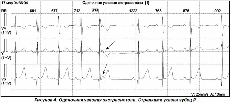 парная экстрасистола. парная суправентрикулярная экстрасистолия. групповые желудочковые экстрасистолы на экг. наджелудочковая экстрасистолия на экг. парная экстрасистола.