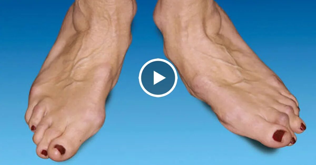 Воспаление сустава стопы. Артрит большого пальца стопы. Артрит суставов пальцев стопы. Воспаление сустава большого пальца стопы. Артрит суставов пальцев стопы.