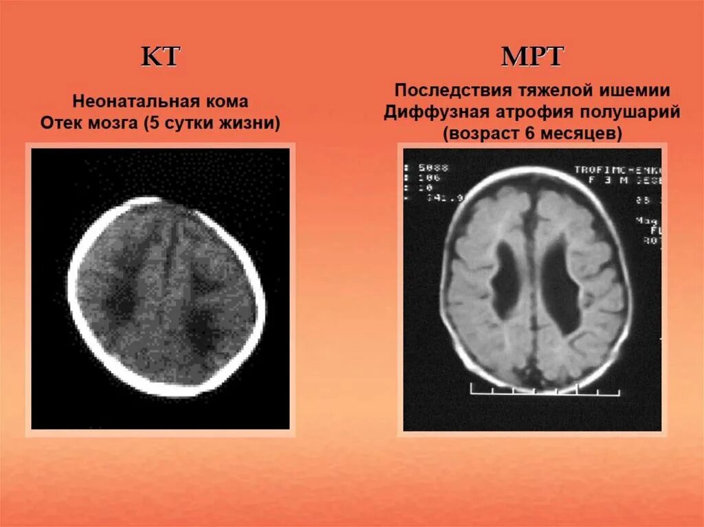 Гипоксически ишемическое поражение мозга. Гипоксическое поражение головного мозга кт. Гипоксически- ишемическое поражение ЦНС кт. Гипоксическая энцефалопатия на мрт. Гимоксияески ишемический поражения головного мозга.