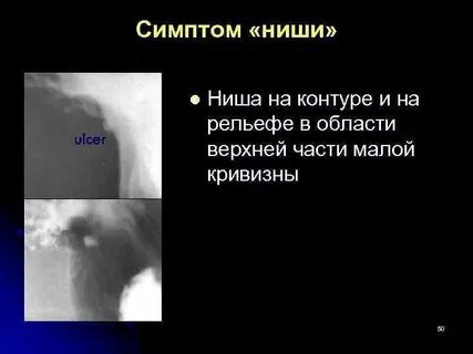 Симптом ниши