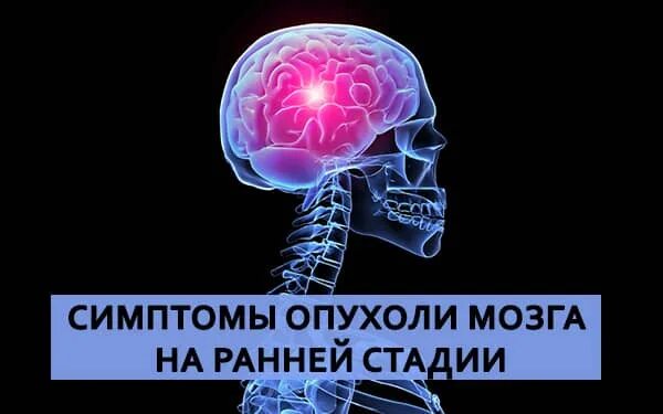 Головного мозга на ранних. Опухоль головного мозга симптомы. Опухоль головного мозга на ранних стадиях. Опухоль мозга первые симптомы. Признаки головного мозга.