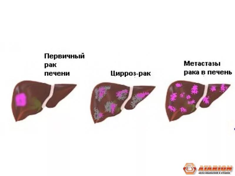 Первичные опухоли печени.