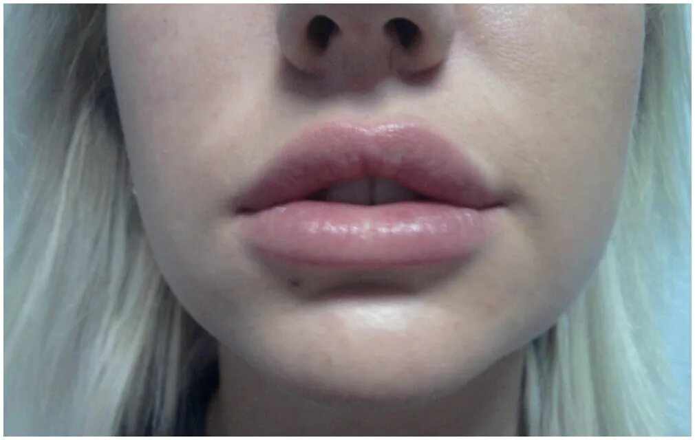 Скольки лет можно увеличить губы. Увеличенные губы красивые. Губы накаченные гиалуроновой. Накаченные губы красивые формы. Увеличение губ гиалуроновой кислотой.