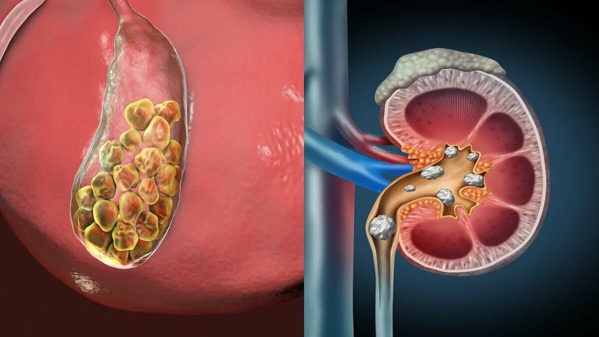 Камни в почках и желчном пузыре