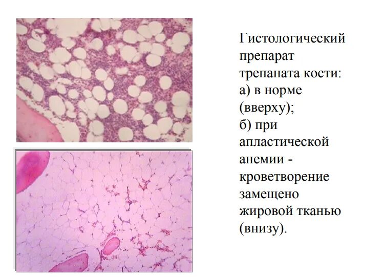 Результаты костного мозга. Апластическая анемия костный мозг. Костный мозг при апластической анемии. Гипопластическая анемия картина крови. Картина костного мозга при апластической анемии.