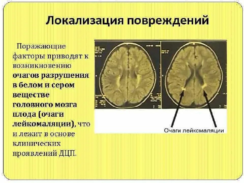 Дцп мозг. Изменения в головном мозге при ДЦП. ДЦП локализация поражения.