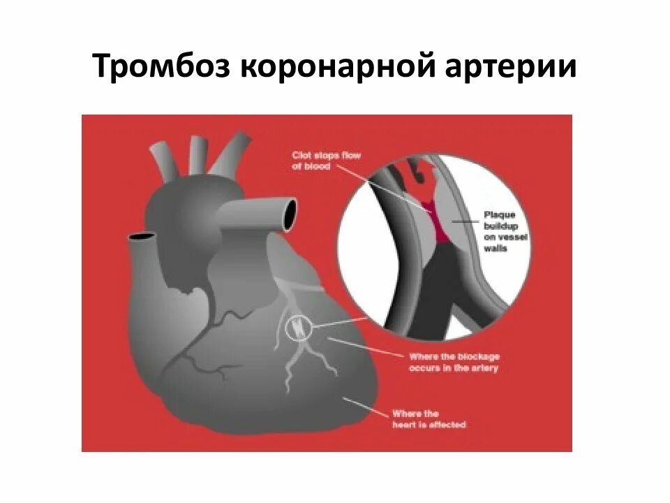 Тромбоз коронарной артерии. Тромб в коронарной артерии. Образование тромба в коронарной артерии. Тромбоз правой коронарной артерии. Сердечный тромбоз