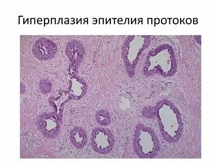 Пролиферация железистого эпителия nilm