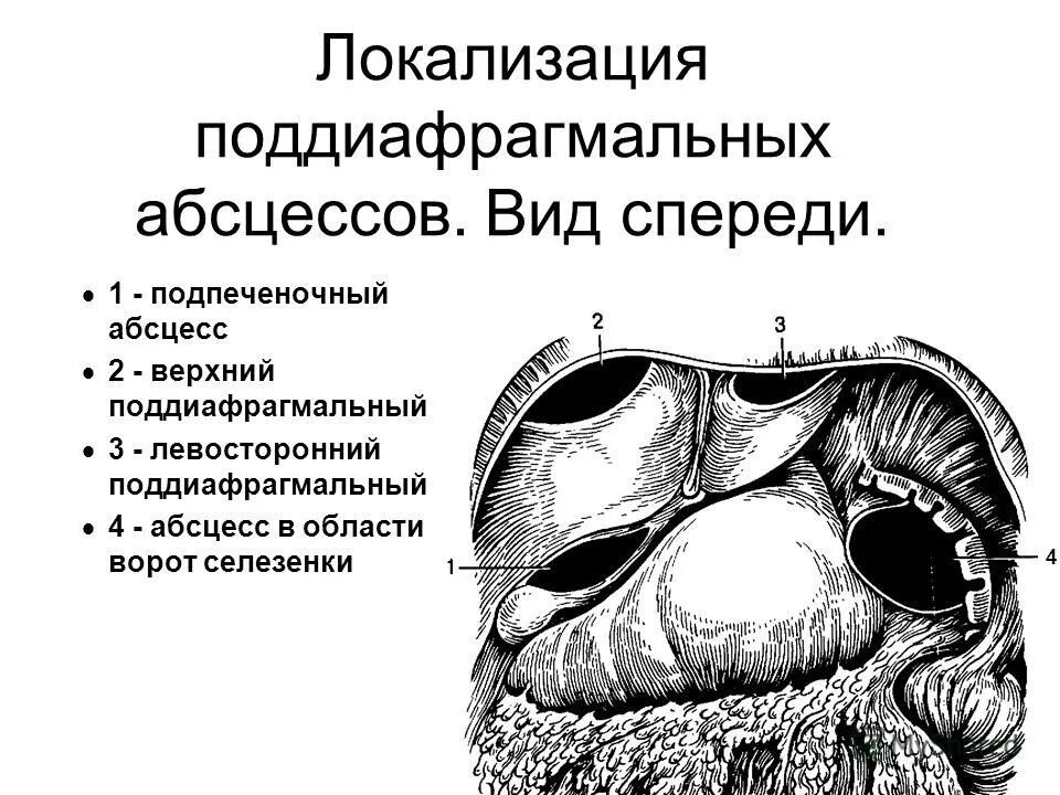 Подпеченочный абсцесс. Поддиафрагмальный инфильтрат. Внебрюшинный поддиафрагмальный абсцесс. Поддиафрагмальный абсцесс кт. Подпеченочный абсцесс кт.