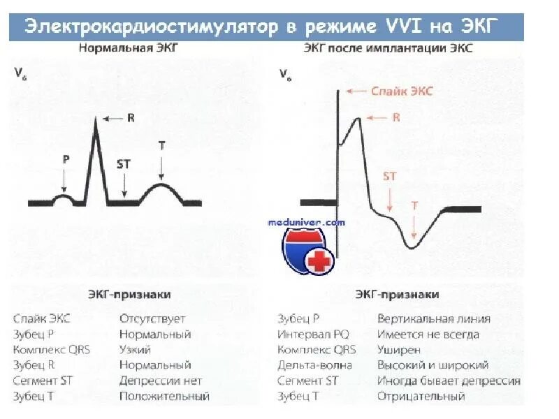 Ритм двухкамерного кардиостимулятора на ЭКГ. Режимы кардиостимуляторов на ЭКГ. Нарушения работы кардиостимулятора на ЭКГ. Желудочковый кардиостимулятор на ЭКГ.