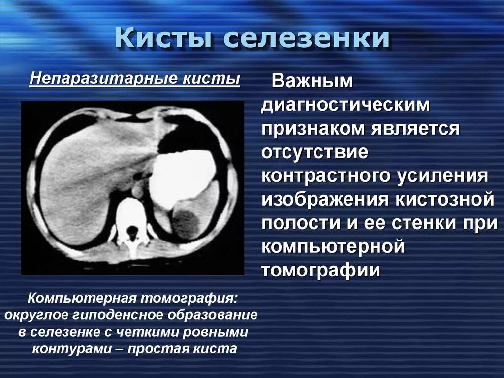 Киста селезенки лечение. Субкапсулярная киста селезенки кт. Селезенка Гиста. Паразитарная киста селезенки на кт.