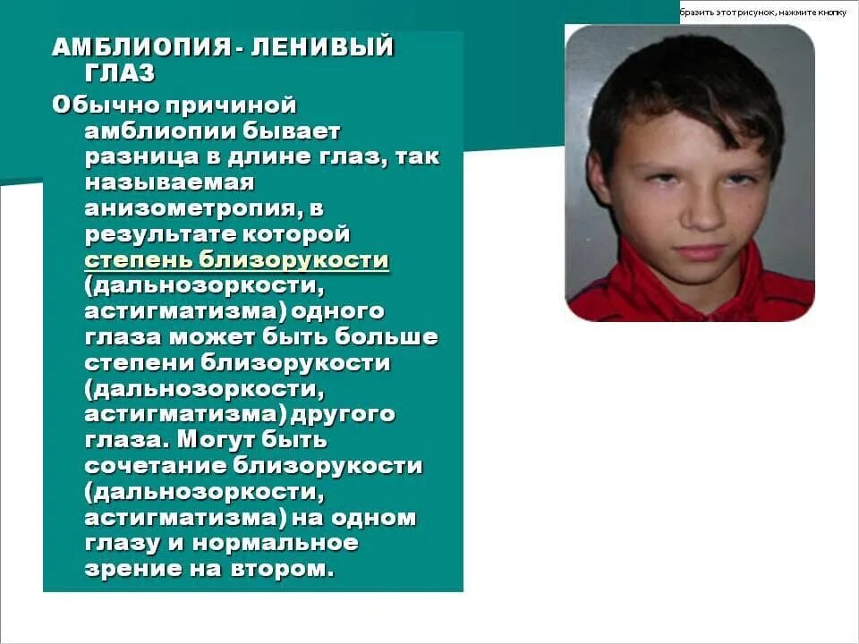 Анизометропия это в офтальмологии. Амблиопия. Амблиопия у детей. Амблиопия средней степени у детей.