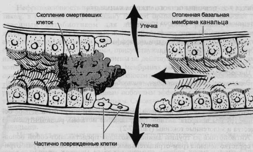 Некроз эпителия извитых канальцев почки. Острый канальцевый некроз патогенез. Базальная мембрана канальцев. Базальная мембрана канальцев. Внутриканальцевая обструкция.