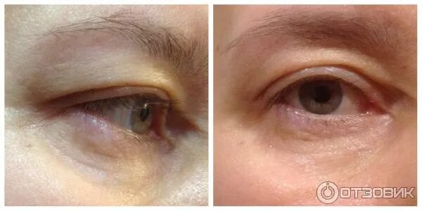 PRP face lift results Vaseline beauty tips, Health, beauty, Beauty care