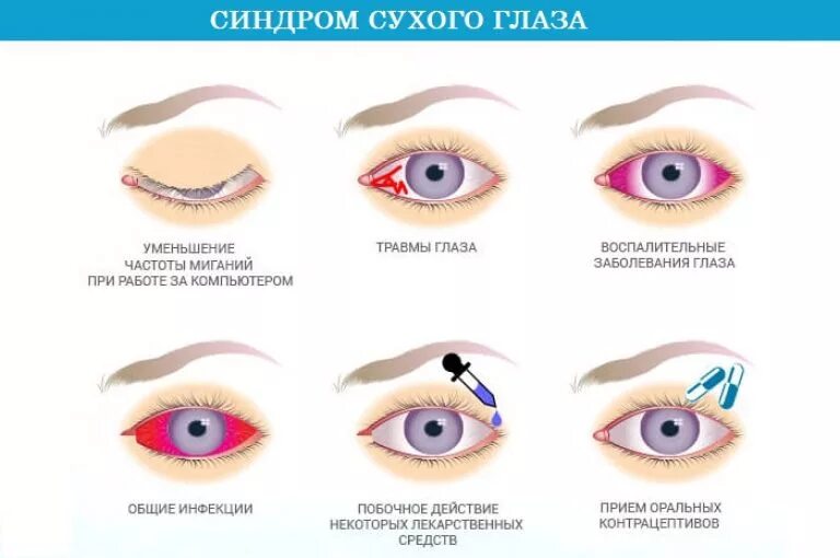 Синдром сухого глаза симптомы. Коньюктивит коньюктивит коньюктивит. Причины развития синдрома сухого глаза. Признаки синдрома сухого глаза.