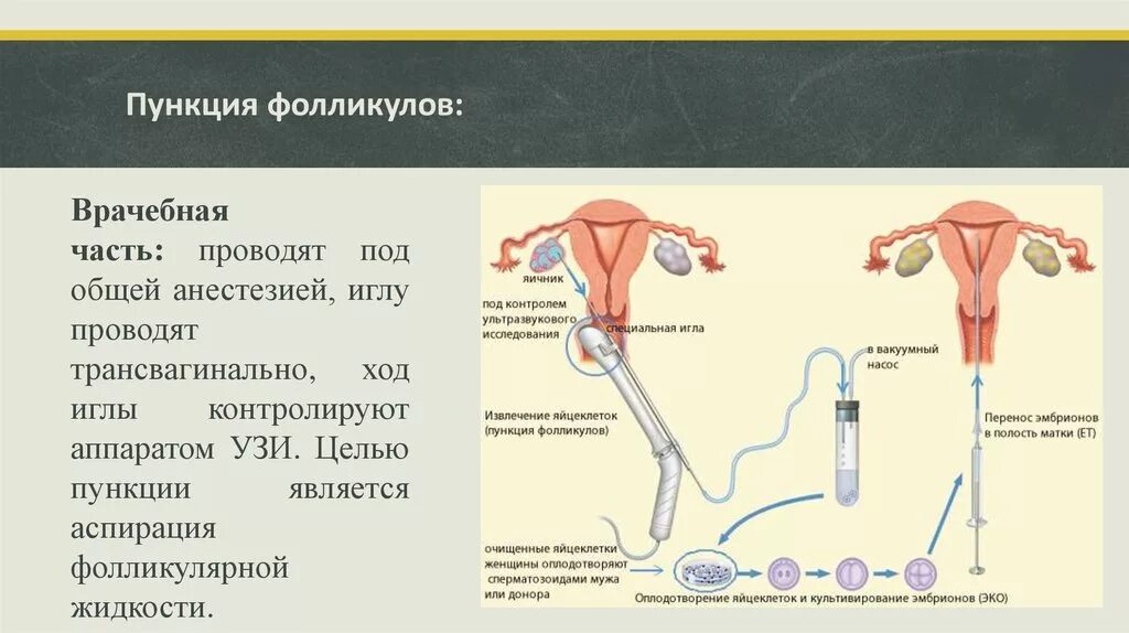 Как берут яйцеклетку для эко. Пункция забора яйцеклетки. пункция яичников ооцитов. пункция фолликулов при эко. трансвагинальная пункция яичников.