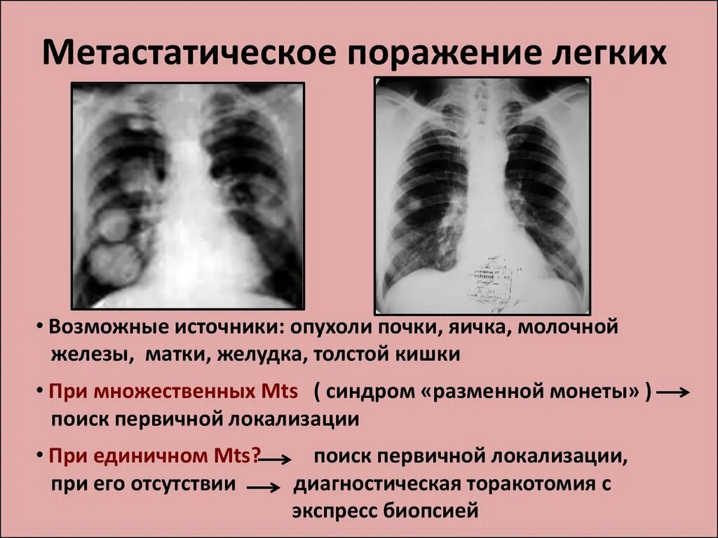 Поражен легких 3. Метастатическое поражение легких рентген. Поражение легких при коронавирусе. Метастатические опухоли легких.