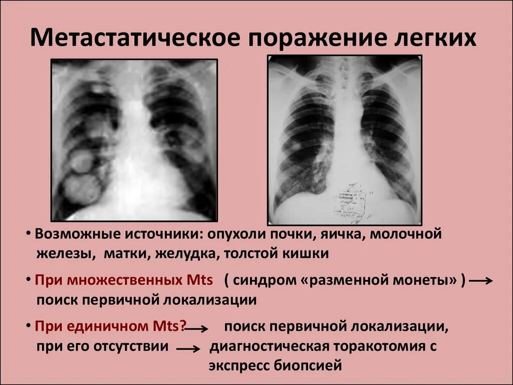 Легкие после поражения