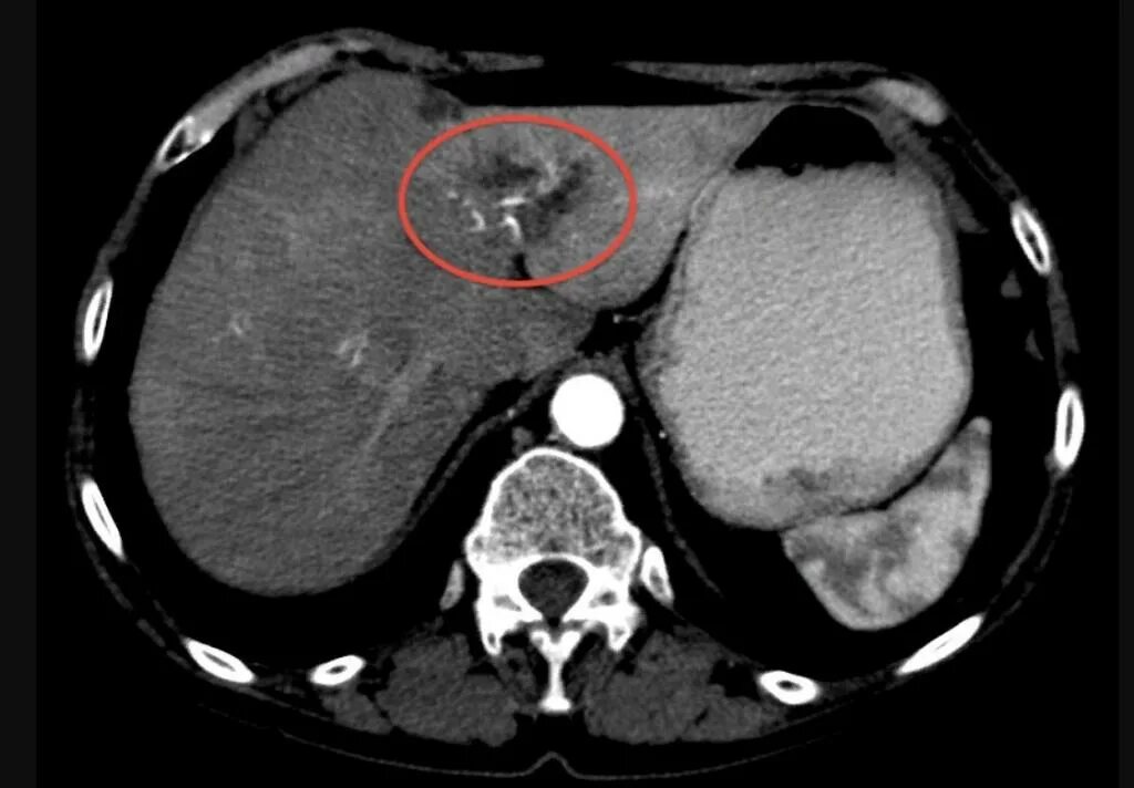 Гиперваскулярные метастазы печени кт. Гиперваскулярные образования печени на кт. Гиподенсный очаг печени кт. Гиповаскулярное образование в печени на кт что это. Гиперваскулярное образование печени