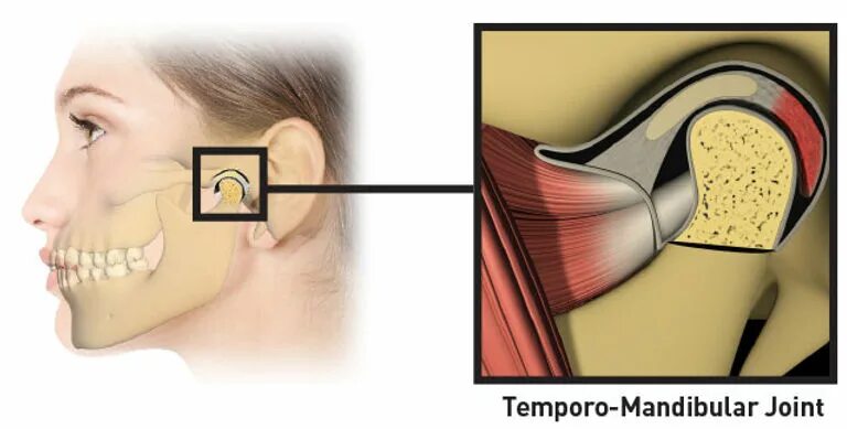 Внчс уха. Артрит височно-нижнечелюстного сустава симптомы. Травматический артрит ВНЧС.