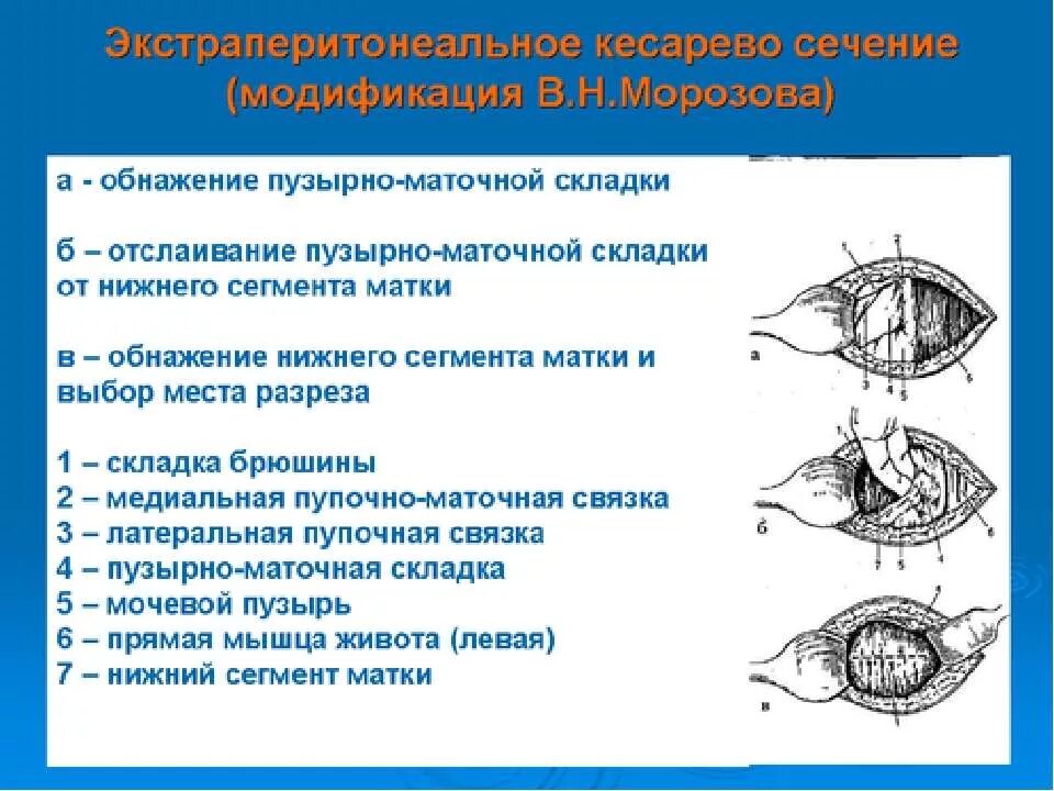 Сечение матки операция. Экстраперитонеальное кесарево сечение. Пузырно маточная складка. Экстраперитонеальное кесарево сече. Поперечный разрез Нижнего сегмента матки.