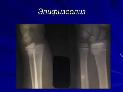 Эпифизеолиз это