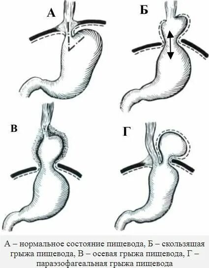 Грыжа пищевода признаки симптомы. Грыжа пищеводного отверстия пищевода симптомы. Скользящие и параэзофагеальные грыжи пищеводного отверстия. Грыжа пищеводного желудка. Хиатальная грыжа пищевода скользящая.